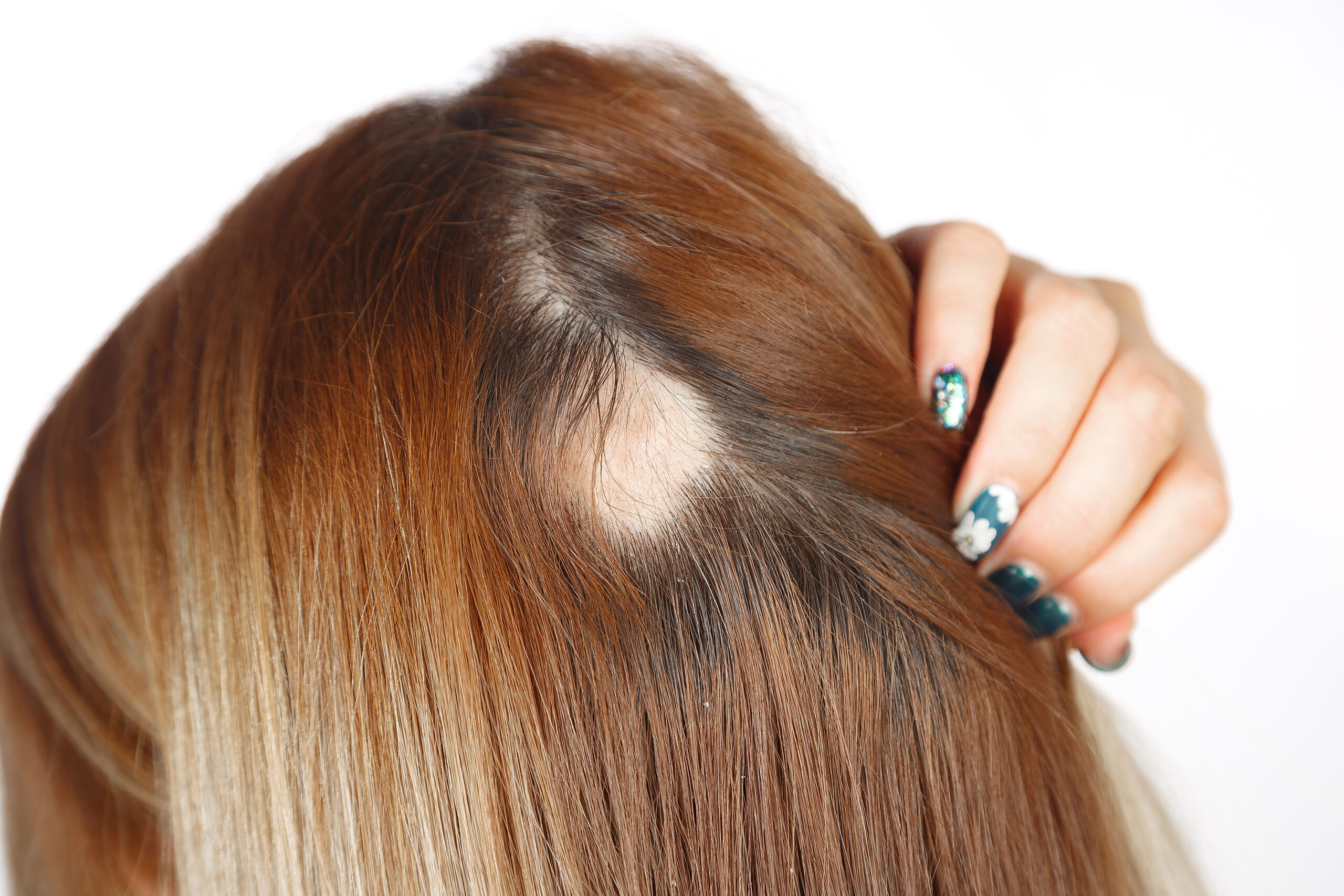 30,Year,Old,Caucasian,Woman,With,Spot,Alopecia,,Bald,Spot